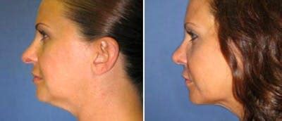 Facial Liposuction Before & After Photos | CosmetiCare