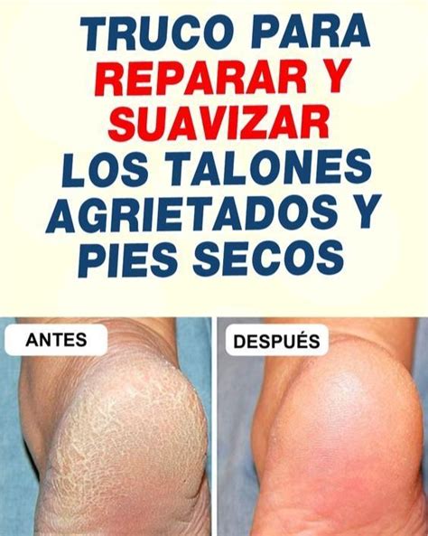 El Truco Para Reparar Y Suavizar Los Talones Agrietados Y Pies Secos