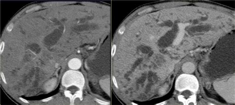 The Radiology Assistant Biliary Duct Pathology
