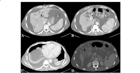 Abdominal Computed Tomography Images Of The Liver Showed Numerous