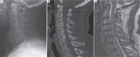 Central Cord Syndrome Neupsy Key