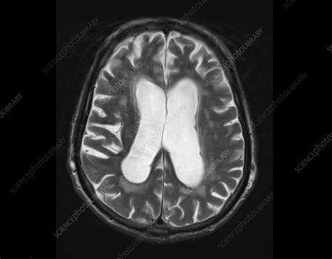 frontotemporal dementia mri  ct scans stock image