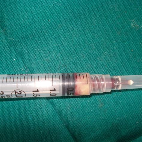 Aspiration Biopsy Revealed A Cheesy Aspirate Download Scientific Diagram