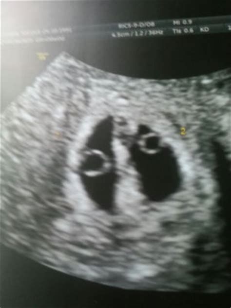 6 weeks with twins hcg levels | BabyCenter