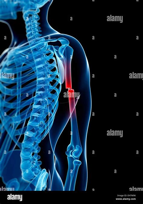 Broken Arm Bone Illustration Stock Photo Alamy