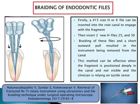 Removal Of Broken Endodontic Instruments Ppt Free Download