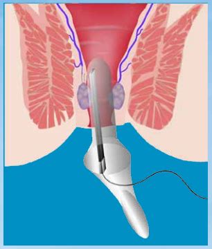 Anal Hastalıklarda Lazer ile Tedavi
