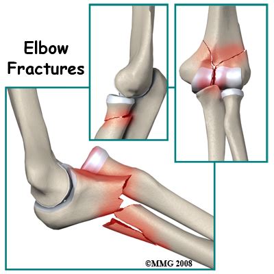 Elbow Fracture 👨‍⚕️singapore Orthopaedic And Neurosurgery Clinic
