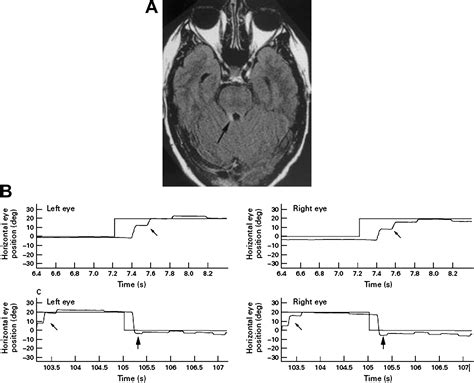 Eye Movement Abnormalities In Multiple Sclerosis Neurologic Clinics