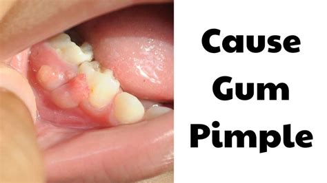 Gum Pimple: Causes & Treatment At Spring Orchid Dental