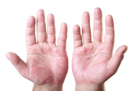 What Are The Symptoms Of Poor Circulation In The Hands