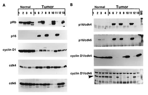 Cyclin E A Redundant Cyclin In Breast Cancer PNAS