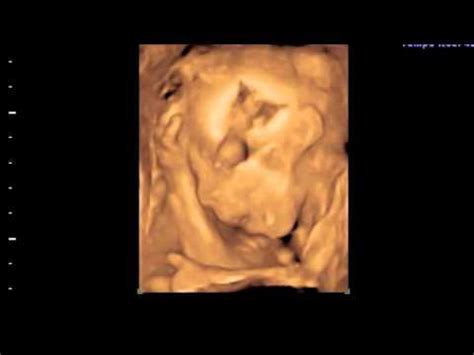 Atlas images echographie ultrasonography 3D 4D in obstetric ,embryon ...