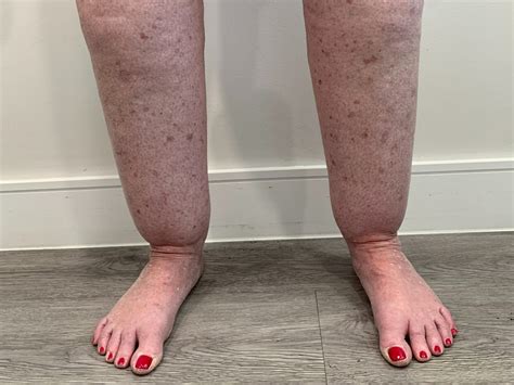 What You Need To Know About Lipedema Tactile Medical