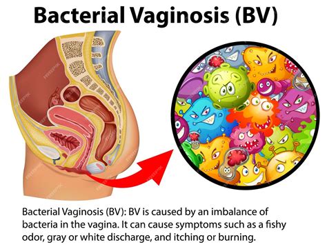 Инфографика бактериального вагиноза bv с объяснением | Бесплатно векторы