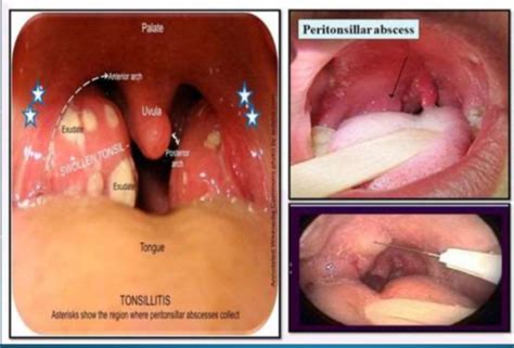 Pharynx And Tonsil Disoders Flashcards Quizlet