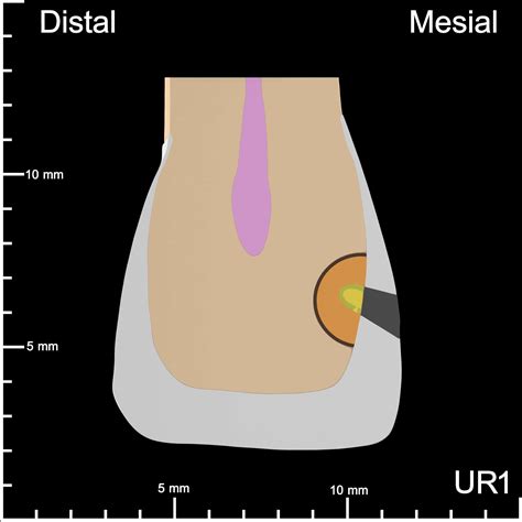 Ur Mesial Decay K Teeth