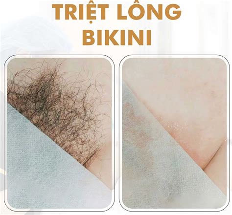 Triệt lông bikini là gì Những kiểu tạo hình triệt lông bikini đẹp