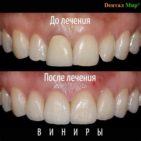 Выбираем виниры | статьи о стоматологии
