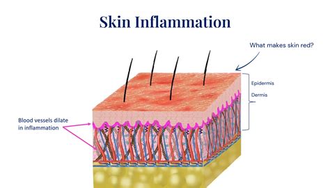 skin inflammation
