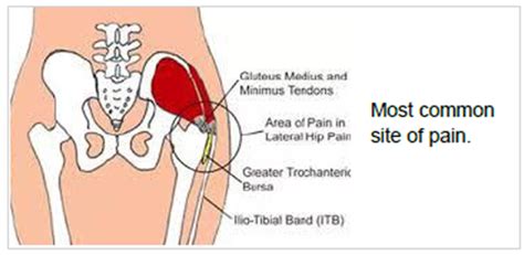 A Pain In The Bum Body And Mind Physiotherapy