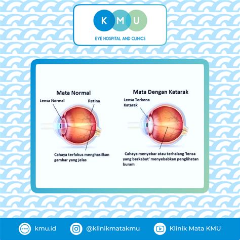 Penyakit Pada Lensa Mata Beserta Pengobatannya