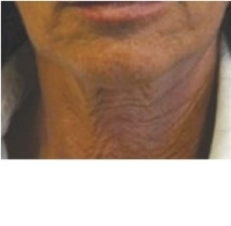 Radiofrequency Skin Tightening and firming in Essex | Woodford Medical