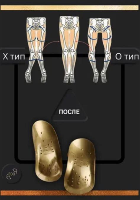 Как избавиться от косточки на большом пальце ноги?