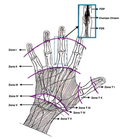 Zones Of The Hand Flexor And Extensor Off