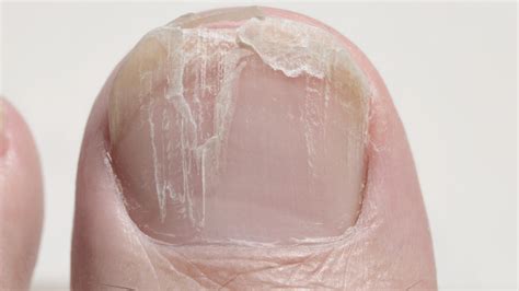 Das kannst du tun, wenn sich deine Fingernägel spalten - Genialetricks
