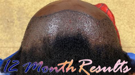 Kylies 12 Month Hair Transplant Results Traction Alopecia Black