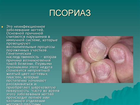 Базовый курс по педикюру. Микоз. Вросший ноготь (урок 5) - презентация ...