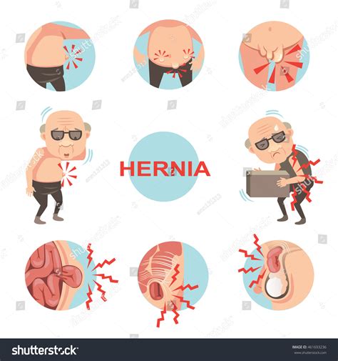 908 Inguinal Hernia Images, Stock Photos & Vectors | Shutterstock