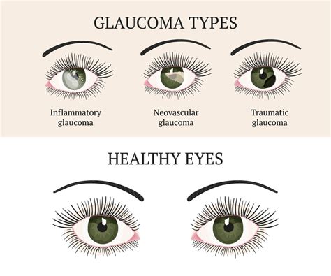 Glaucoma Chart Accent Eye Care