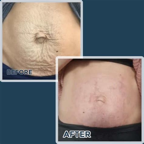 Fibroblast Skin Tightening Coastal Contours And Wellness Skin Care