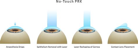 Trans-Epithelial PRK (StreamLight PRK): Advanced No-Touch Vision