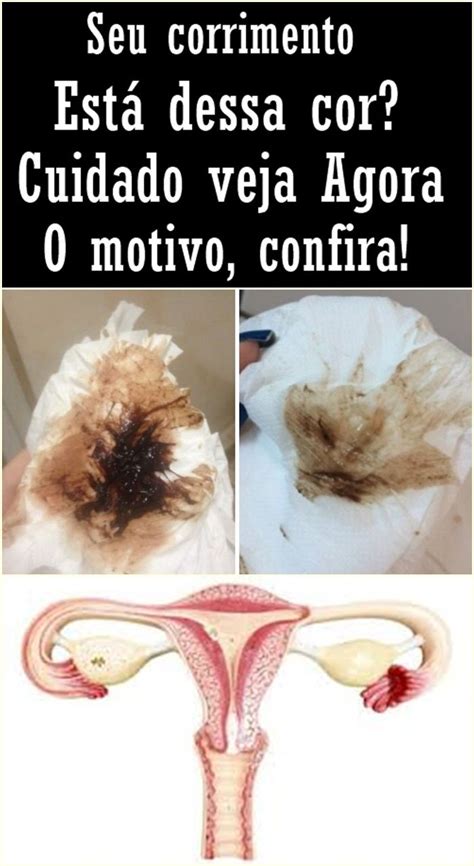 Corrimento Marrom Após A Menstruação - Corrimento Marrom Escuro Antes Da Menstruacao Menstruação Escura: 6