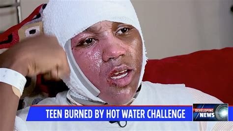 Hot Water Challenge Leaves 15 Year Old Severely Burned