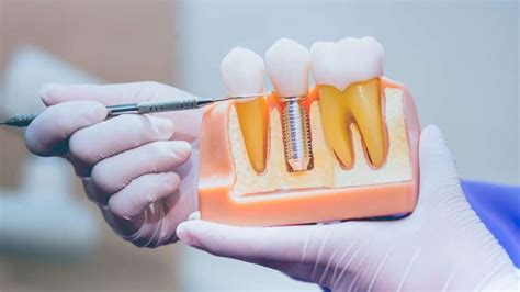 The Complete Guide to Dental Implants: What You Need to Know