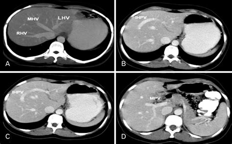 Axial Image Of Contrast Enhanced Computed Tomography Study Of Abdomen