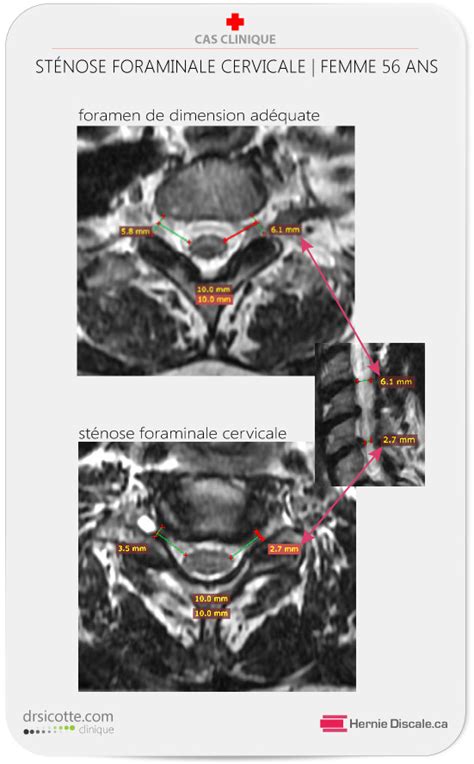 Sympt Mes St Nose Foraminale Cervicale Hot Sex Picture