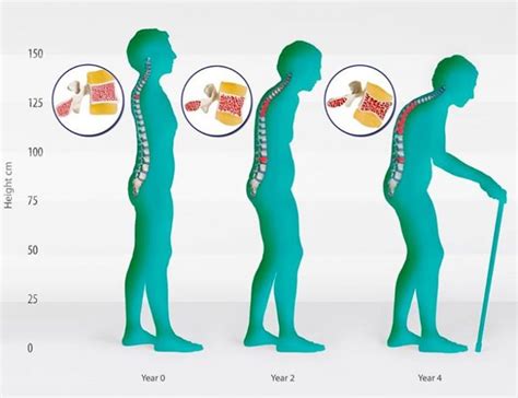 Blog Of The Week Posture And Osteoporosis Classically When Women Are Diagnose Mat Boulé