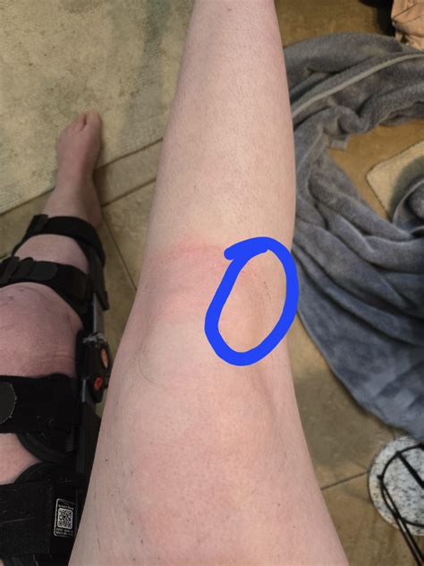 Bump On Knee Why Your Knee Feels Tight When Bending | Knee Pain When