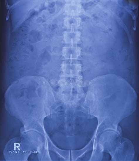 X Ray Of Kub Region Bowel Gas And Fecal Matter Stock Image Image Of