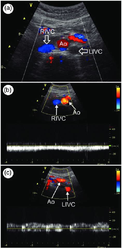 Colour Doppler Ultrasonography Images Of The Abdomen Scanned At The L