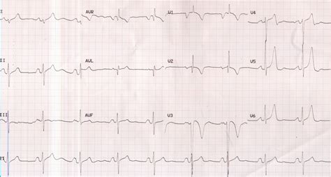 P Mitrale And Right Ventricular Hypertrophy All About Cardiovascular