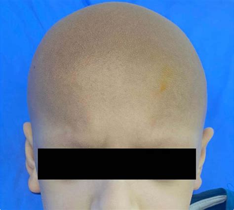 Figure From Ichthyosis Follicularis Alopecia And Photophobia