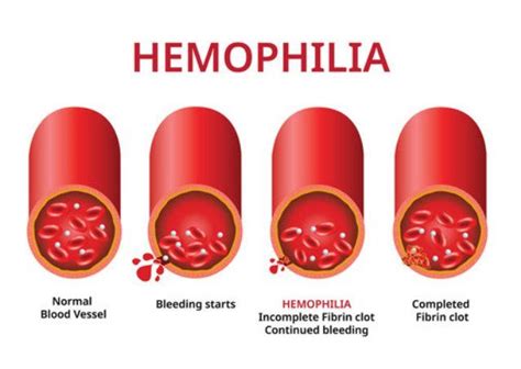 Hemofilia Penyebab Gejala Penanganan Pencegahan Dan Dokter