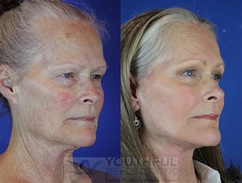 Ultra Laser Face Lift at Georgia Challis blog