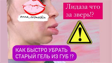 Как убрать старый гель из губ ! Лидаза , лонгидаза отличия ! Процедура ...